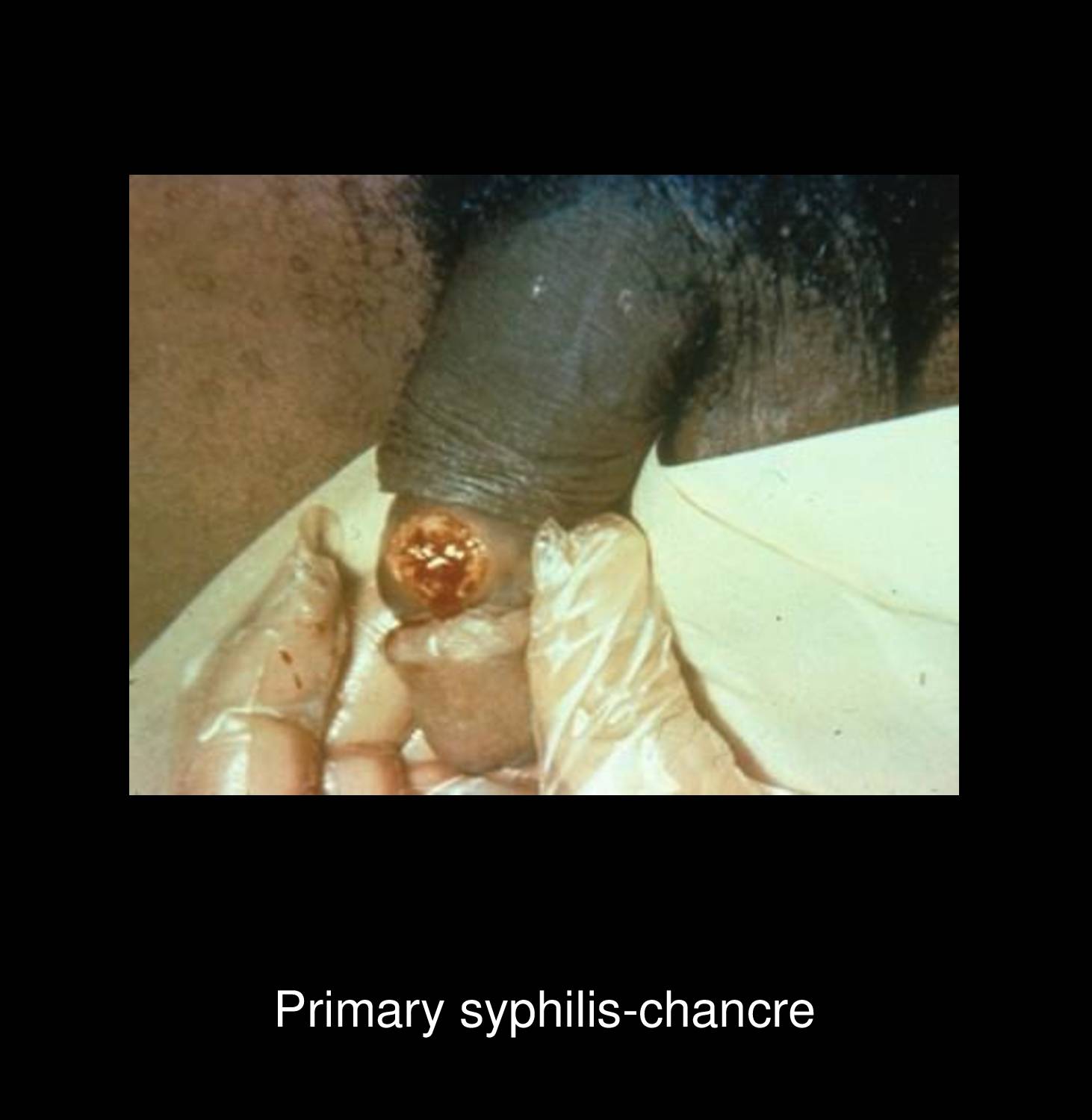 Secondary syphilis rash on palms showing characteristic copper-colored papulosquamous lesions pathognomonic for Treponema pallidum dissemination